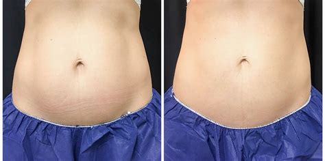 CoolSculpting Results_2 - the Flexman Flat