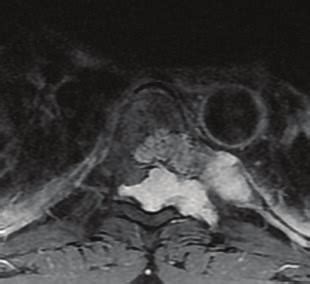 Axial Post Contrast MRI Image Showing Brilliant Post Contrast