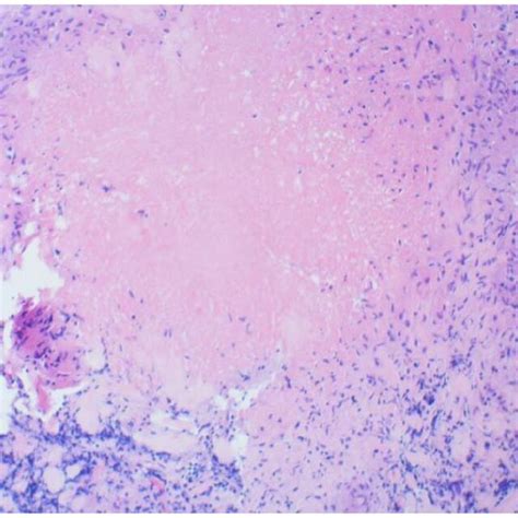 Necrotizing granuloma found on pleural biopsy. | Download Scientific Diagram