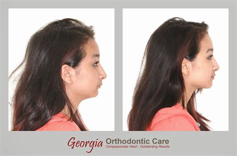 Georgia Orthodontic Care Lawrenceville And Norcross Ga Patient With