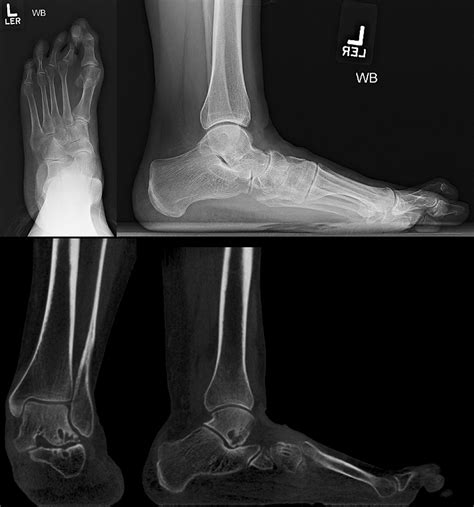 Adult Acquired Flatfoot Deformity Jensen K Henry Rachel Shakked Scott J Ellis 2019