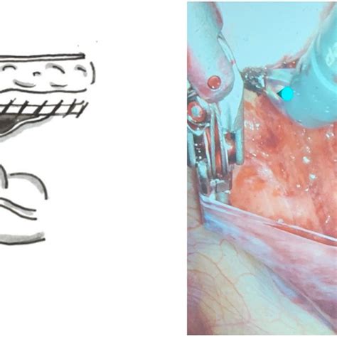 The Sugarbaker Technique For Repair Of Parastomal Hernias Is