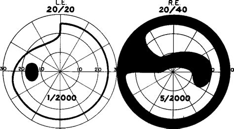 Figure 3 from THE BJERRUM SCOTOMA. | Semantic Scholar