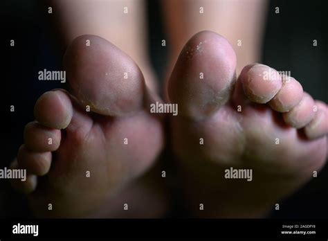 Tinea Pedis Fotografías E Imágenes De Alta Resolución Alamy