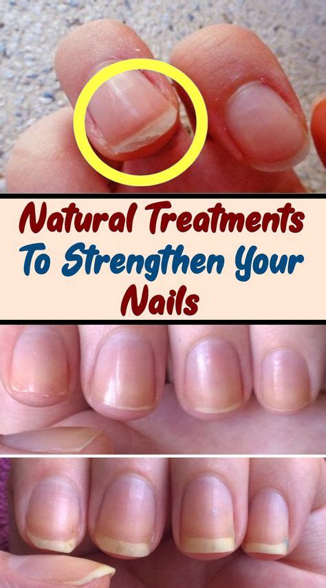 Natural Treatments To Strengthen Your Nails Wellness Leak