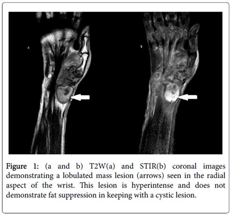 Infectious Diseases Therapy Cystic Lesion