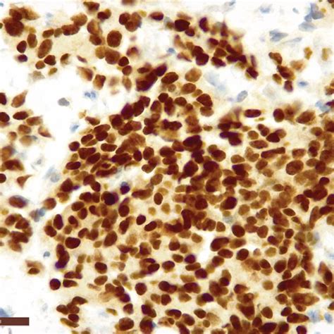 Cells Showing Round Or Ovoid Nuclei With Fine Saltandpepper Chromatin