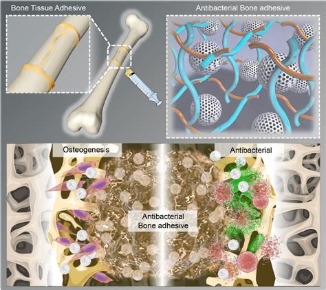 Figure 1 From Triple Functional Bone Adhesive With Enhanced Internal