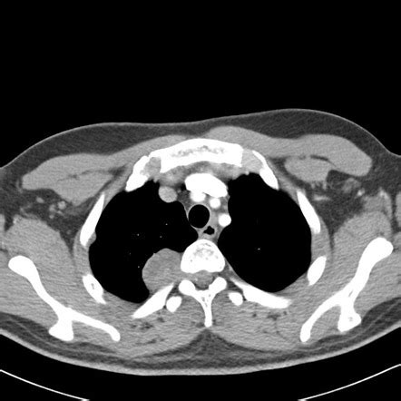 Multiple Schwannomas Image Radiopaedia Org