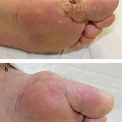 A Plantar Warts Before Treatment B Resolution Of Plantar Warts After