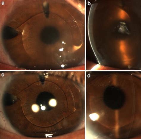 Slit Lamp Photographs Before And At 6 Months After Dmek For Bk