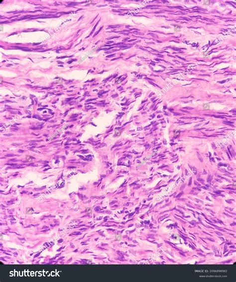 Uterus Wall Proliferative Phase Adenomyosis Show Stock Photo 2096898982