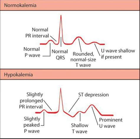 Ecg Changes Associated With Hypokalemia And Hyperkalemia Medical