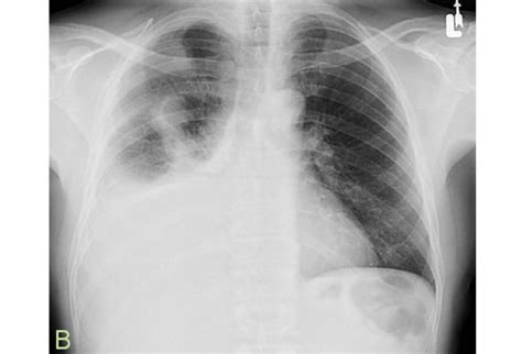 Thoracentesis Best Practices Slideshow