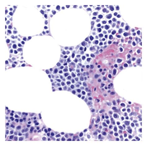 A Bone Marrow Infiltrated By Plasma Cells B Bone Marrow