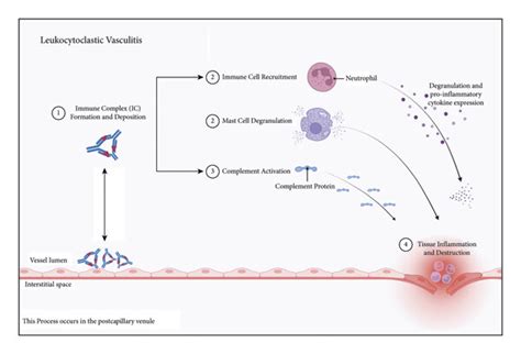 Pathophysiology Of Leukocytoclastic Vasculitis Immune Complexes Are