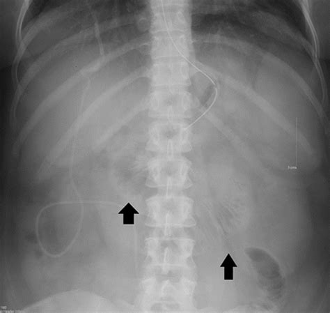 Review Of Small Bowel Obstruction The Diagnosis And When To Worry