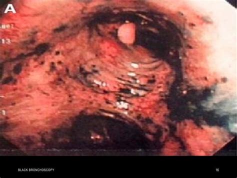 Black Bronchoscopy Ppt