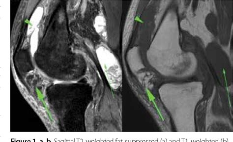 Figure 1 From Heterotopic Ossification Myositis Ossificans Progressiva A Condition