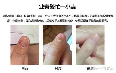 灰指甲不得不看的 甲分离型20真实案例合集（详图版） 知乎