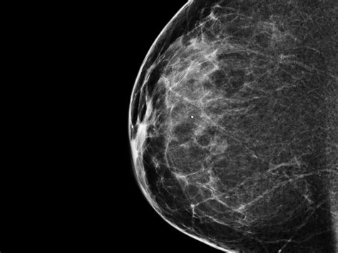 Is 3 D Mammography Worth The Extra Expense Shots Health News Npr