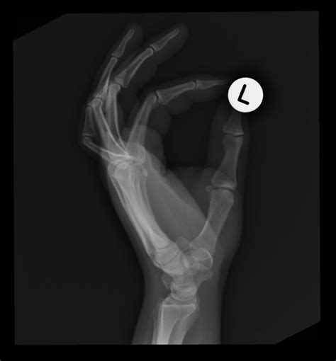 Radiopaedia Case Old Avulsion Fracture At Metacarpophalangeal Joint Id