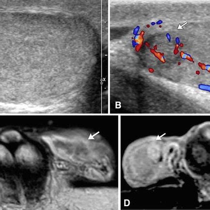 Fibrous Pseudotumor Color Doppler Image A Demonstrates The Presence