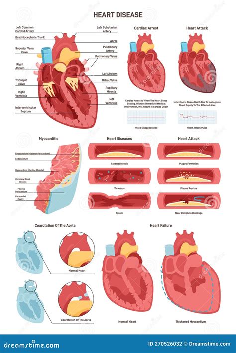 Hartziekten Anatomie Van Het Hart En De Omringende Bloedvaten Vector