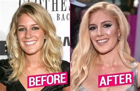 Heidi Montag Plastic Surgery Transformations – Before and After