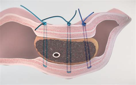 Hepato Pancreato Biliary Tvasurg The Toronto Video Atlas Of Surgery