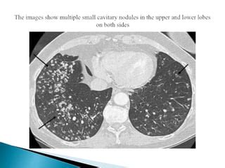 Differential diagnosis of cavitary lung lesions | PPT