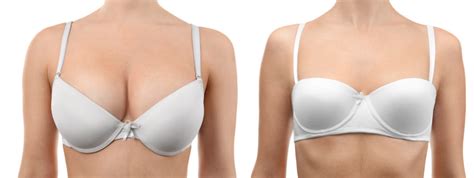 Saline and Silicone Breast Implant Removal | Dallas, TX