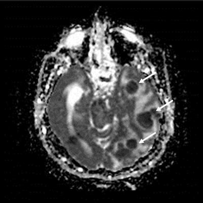 The Diffusion Weighted Image Of Axial Brain Mri Restricted Diffusion