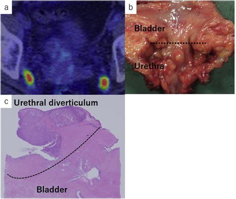 Female Urethral Cancer