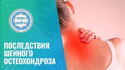 Последствия остеохондроза шейного отдела: стадии болезни и проблемы