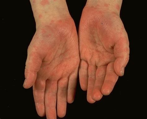 Red Palms Symptoms Causes Treatment Pictures