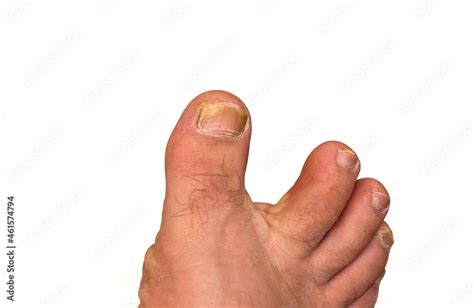 Onychomycosis Is A Fungal Infection Of The Nail Mycosis Of The Foot