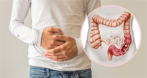 Constipation As Sign Of Bowel Cancer That Has Spread To The Bones