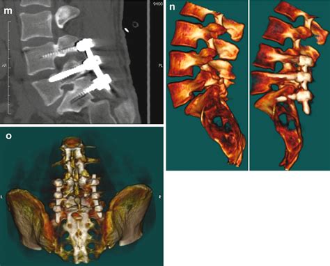 Ct X Ray Guided Technique In Posterior Lumbar Spine Fusion Springerlink