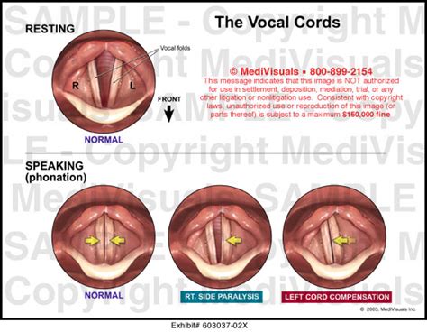 Medivisuals The Vocal Cords Medical Illustration