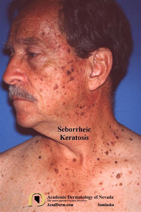 Seborrheic Keratosis: Barnacles of life... - Academic Dermatology of Nevada