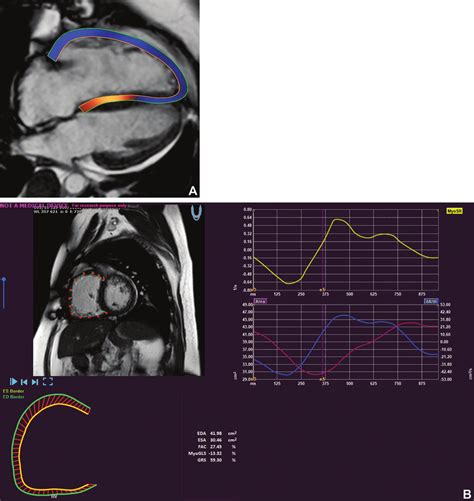 RV strain map. (A) Four-chamber cine SSFP image shows RV strain ...