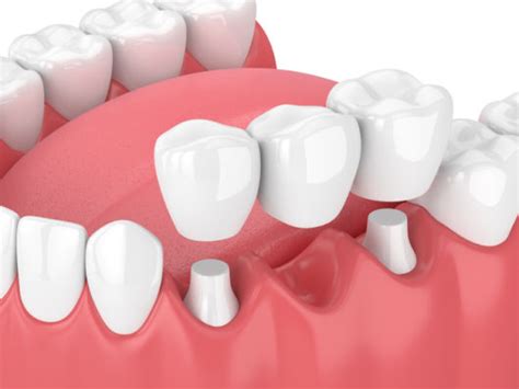 Pros and Cons of Dental Bridges | Dr Stone, DDS