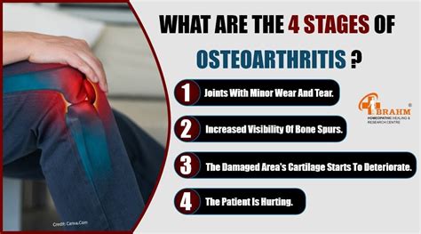 Osteoarthritis Treatment What Are The 4 Stages Of By Brahmhomeo