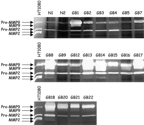 Vascular Endothelial Growth Factor Expression Correlates With Matrix