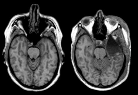 Medial Temporal Lobe Epilepsy