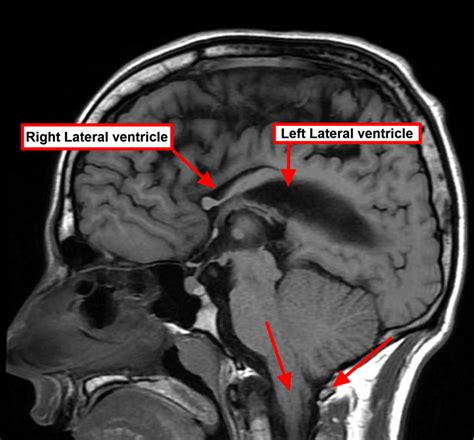 Chiari Malformation Causes Symptoms Prognosis Diagnosis Treatment