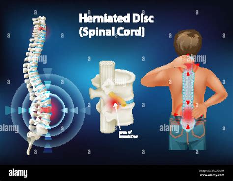 Diagram Showing Herniated Disc Illustration Stock Vector Image And Art