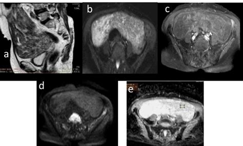 Female Patient 60 Years Old Presented By Postmenopausal Bleeding