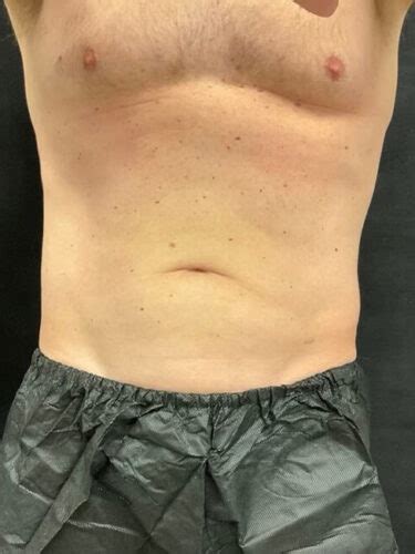 Before And After Body Coolsculpting Bonaldi Aesthetics Plastic